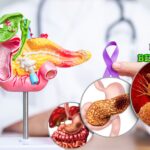 Gejala Kanker Pankreas Lewat Perubahan Feses