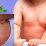 9 Penyebab Bintik Merah pada Bayi yang Harus Diketahui Bunda