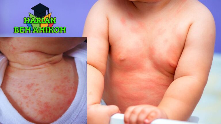 9 Penyebab Bintik Merah pada Bayi yang Harus Diketahui Bunda
